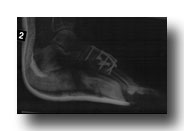 Foot X-Ray